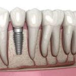 Dental Implants Turkiye